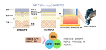 热玛吉的原理是什么?