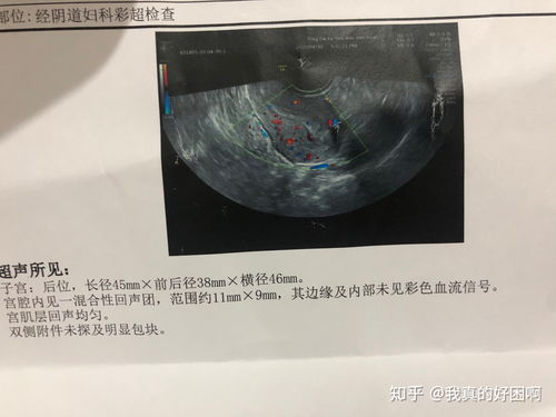 药流成功 不清宫 药流没那么可怕 