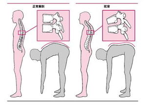 如何矫正驼背