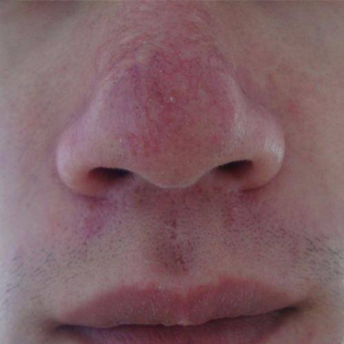 红鼻子,酒槽鼻的病发原因,以及发展变化