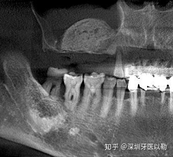 种植牙 上颌窦外提升 