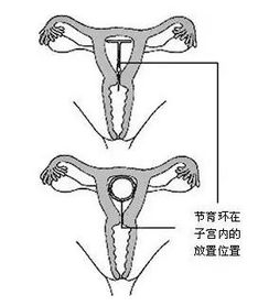 天津百信医院 未婚女性可以戴环避孕吗 