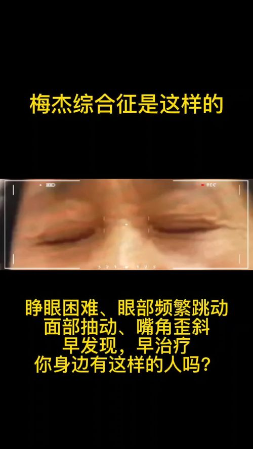 梅杰综合征属这个样子 