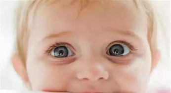 宝宝眼屎多怎么办 如何护理宝宝的眼睛