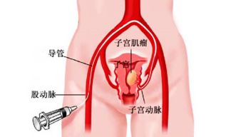 子宫肌瘤最怕4种食物