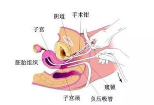 关于人流后以第一个月来月经，很多的，这个正常吗？几天结束啊？的问题