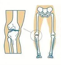 不良体态矫正第六讲 O型腿