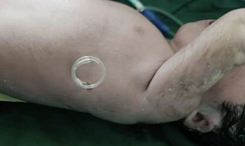 “猪尾巴管”插进胎儿胸腔！6月大胎儿在子宫里行极限手术