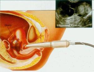人工受孕的过程？人工受精的过程