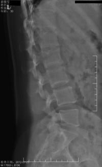 腰椎横突l2l3骨折图片 搜狗图片搜索