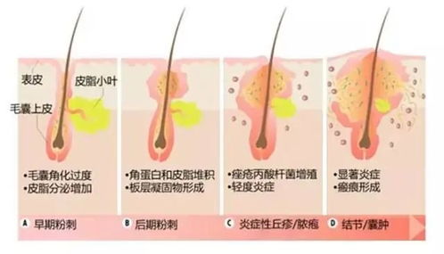 痘痘肌日常护理指南