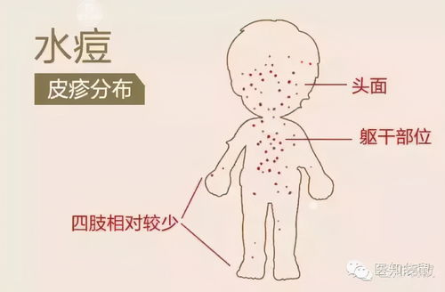 水痘高发期别大意,严重或致脑炎,这个疫苗得安排