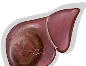 大部分肝癌一发现便是晚期,治愈率不到10 , 请你一定收好