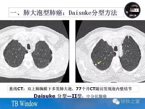 囊腔类肺癌的分型与CT表现