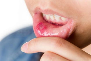 天生口腔溃疡会传染吗,口溃疡会传播吗