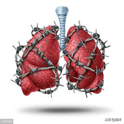 肺纤维化是一种无法根治的疾病,诊治重点是查明病因,对因治疗