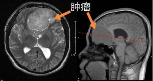 男子嗅觉视觉失灵,没想到脑里长了颗拳头大的肿瘤