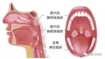 医院专家建议割扁桃体吗 扁桃体到底能不能割为什么