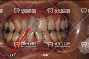 好民生口腔 一颗门牙的 风水 说 前牙美学修复助其事业形象双提升