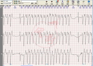 心电图学习20140208 更新图例 心电图脑电图专业讨论版 爱爱医医学论坛 