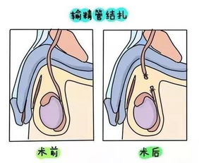 输精管粘堵术实际操作方法