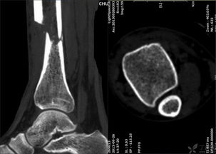 这个骨折你会怎么做