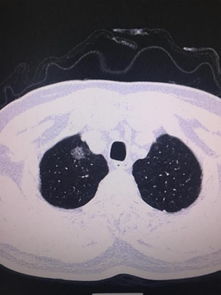 肺部结节吃什么药物可以消失 