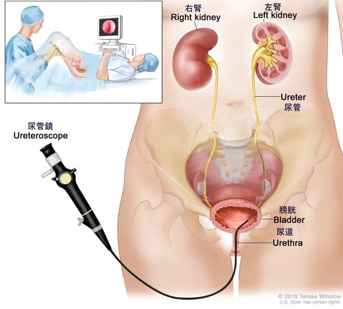 JMT日本就医 出国看病 肾盂 输尿管癌的检查 诊断 疾病分期详解