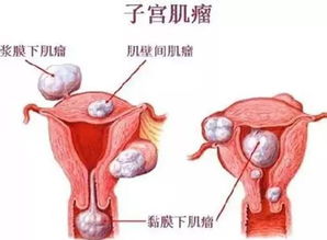 专家建议子宫全切后吃啥 子宫全切后如何保养