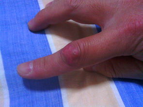 食指关节割伤拆线愈合后无法正常弯曲 