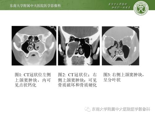 2020.11.05 头颈部疾病 鼻腔鼻窦内翻性乳头状瘤