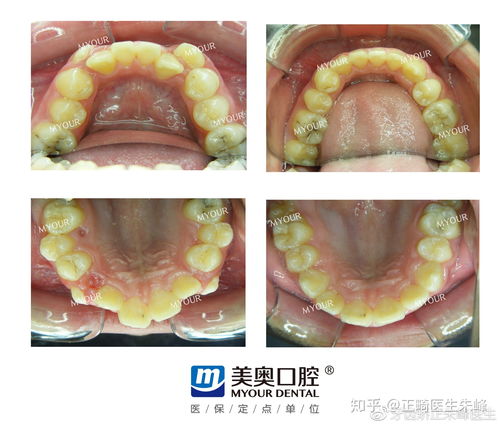 虎牙 是可爱的标志吗 