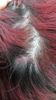 我的头皮上有红点,很疼,这是怎么回事 该怎样治疗 