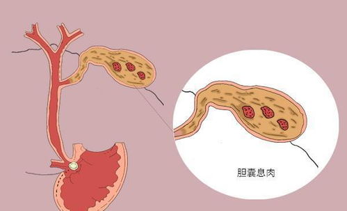 查出胆囊息肉,要不要马上切除 癌变的几率大吗 医生说出答案