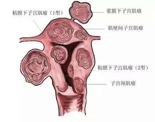 得了子宫肌瘤就不能怀孕了 真是这样吗 