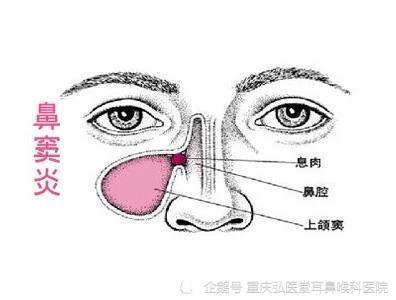 重庆弘医堂医院分享 鼻窦炎会预示什么疾病呢