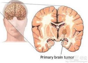 脑膜瘤治疗方法有哪些