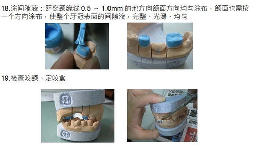 义齿制作工艺流程