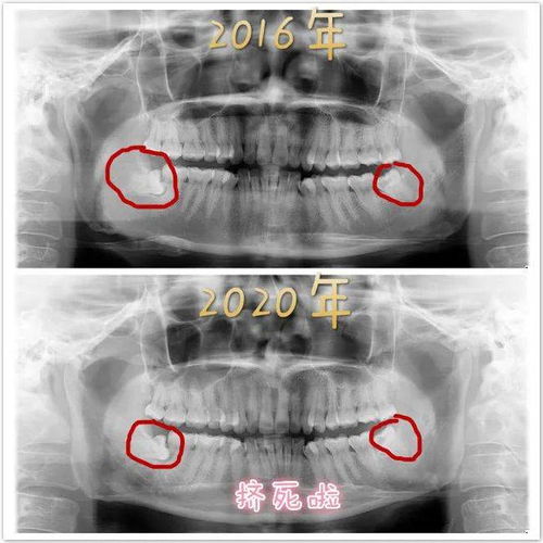 为什么你的智齿会横着长 需要拔吗