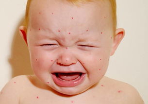 婴儿湿疹怎么预防方法,宝宝湿疹怎么预防?