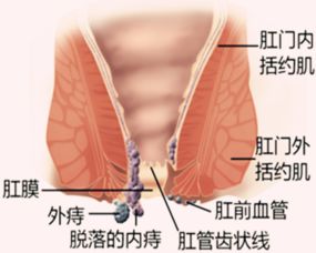 痔疮肿物脱出