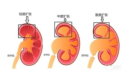 肾积水是得了什么病，严重吗(肾积水是得了什么病,严重吗怎么治疗)