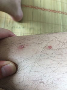 这是梅毒疹吗,只长在四肢上 