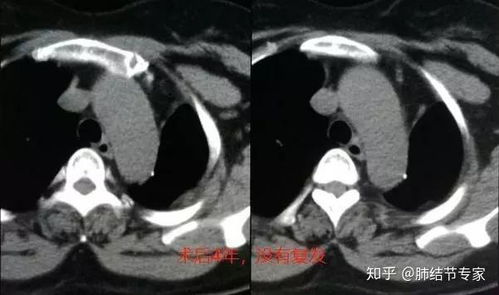 从肺结节长到肺癌晚期需要多久 