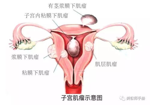 子宫瘤，什么是子宫肿瘤