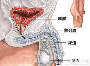 前列腺增生术后症状