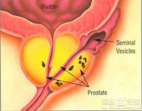 前列腺钙化灶是什么意思
