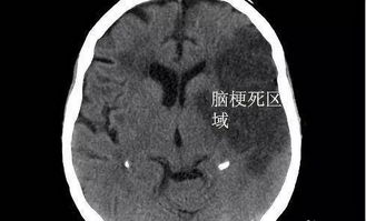 脑梗出现哪四种症状需要赶紧去就医