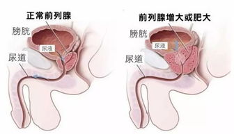 七十岁的老人得前列腺增生有什么中药可以治疗