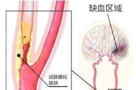 晚上忘吃阿托伐他汀药了,该怎么办呢 看完心里有数了